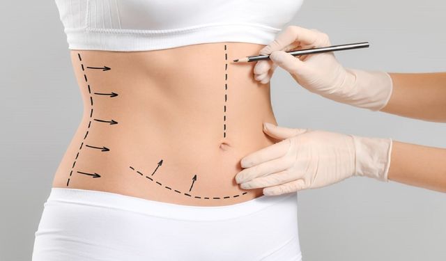 Karın Germe Ameliyatı (Abdominoplasty) Nedir?